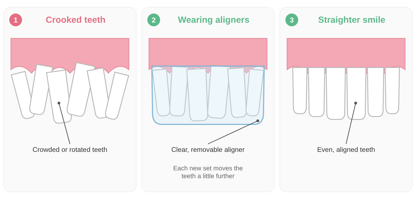 Diagram of clear aligner treatment: crooked teeth, wearing a clear removable aligner, and a straighter smile