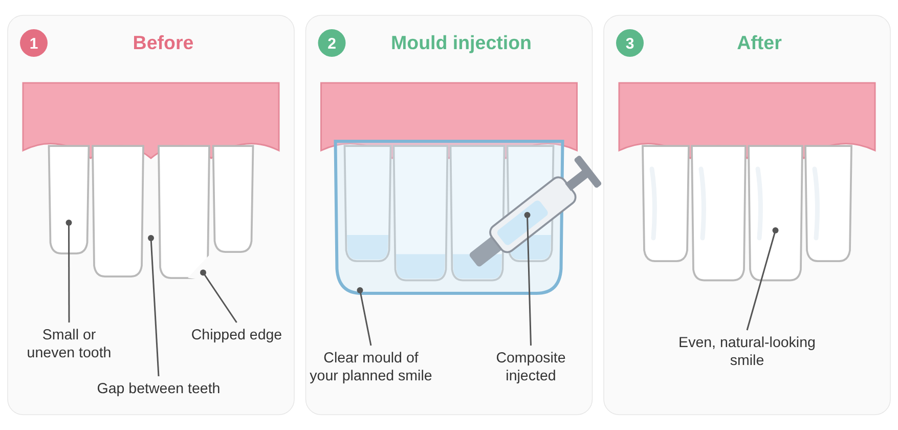 Diagram of composite bonding with the injection moulding technique: chipped and uneven teeth, a clear mould with composite injected, and the even result