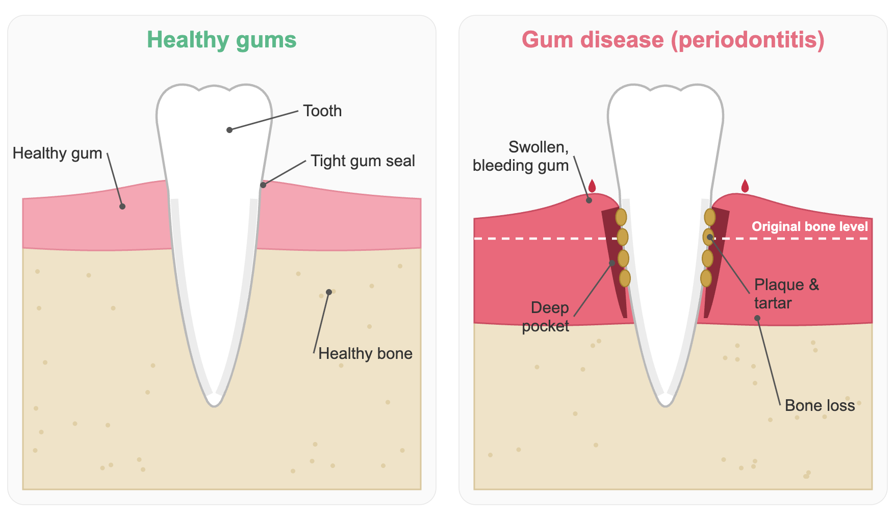 Diagram comparing healthy gums with gum disease (periodontitis): swollen bleeding gums, plaque and tartar, deep pockets and bone loss