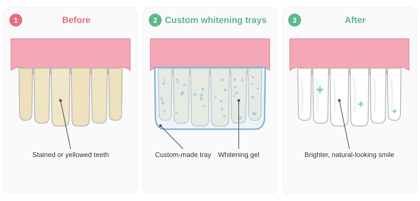 Diagram of professional teeth whitening: stained teeth, custom-made trays with whitening gel, and a brighter natural-looking smile